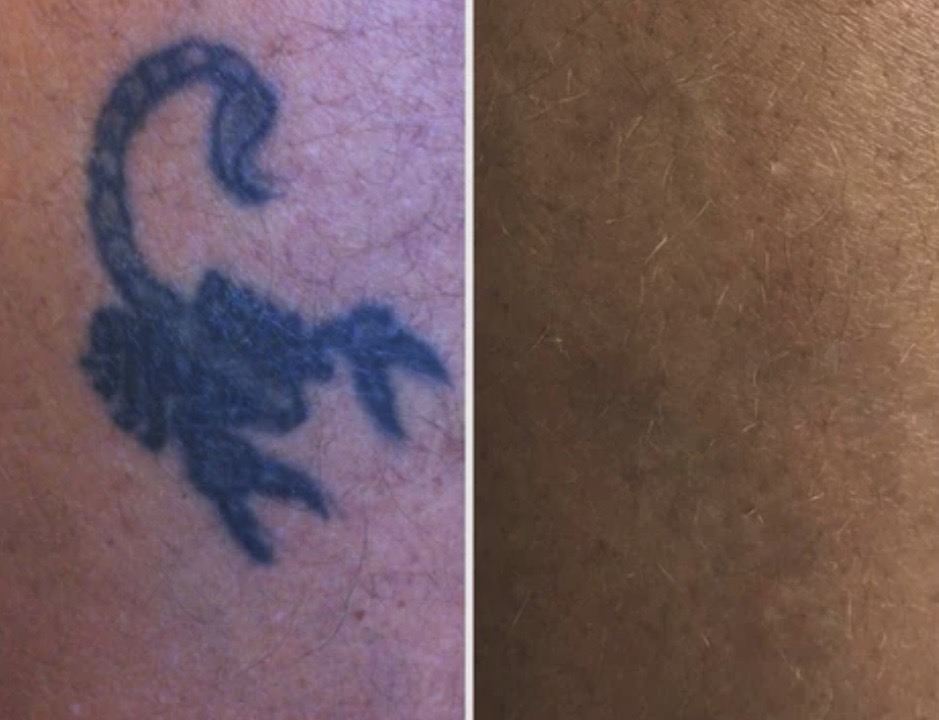 Før og efter laserbehandling 4