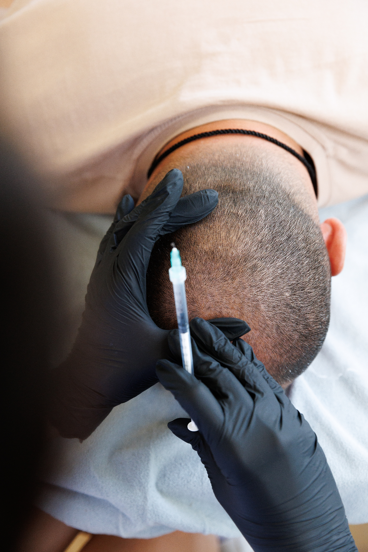 Meso Scalp behandling — MSB