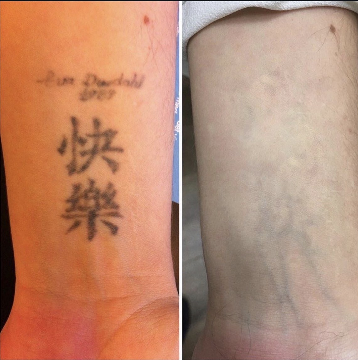 Før og efter laserbehandling 1