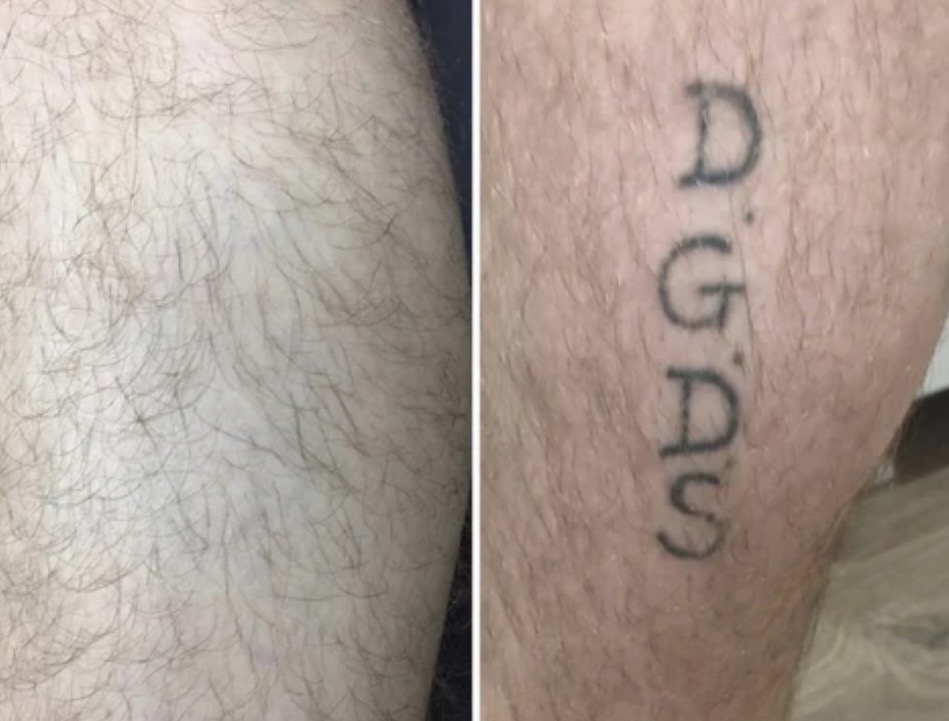 Før og efter laserbehandling 3